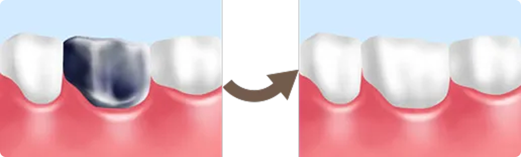 補綴の種類